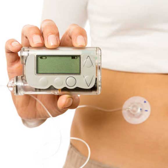 Photo of diabetic insulin pump